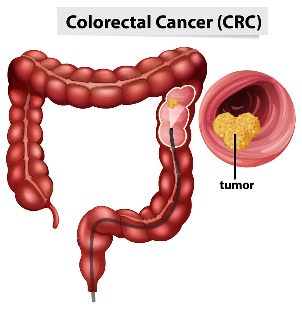 Colorectal Cancer Treatment 